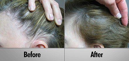 laser hair growth Before and After photos client5