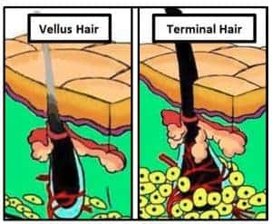 Vellus Hair Terminal Hair