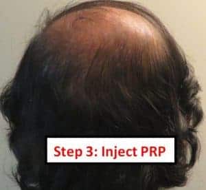 Inject Platelet Rich Plasma Into Bald Areas of Scalp