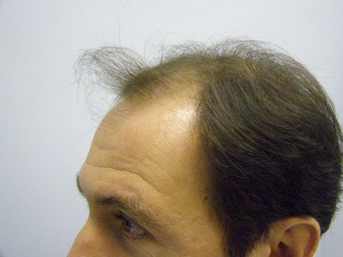 Patient 21 Before Hair Transplant