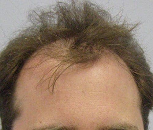 Patient 7 frontal view Before hair transplant