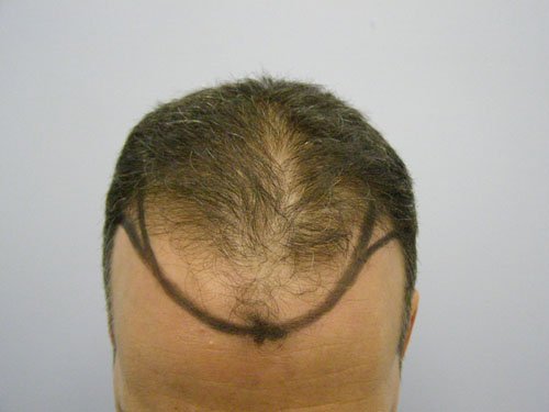 Patient 19 Before Hair Transplant top view