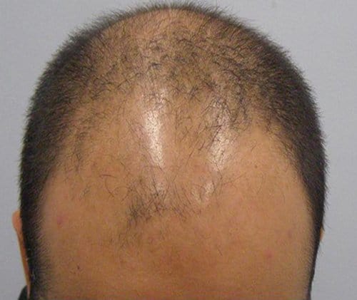 Patient 8 South Asian male top view before hair transplant