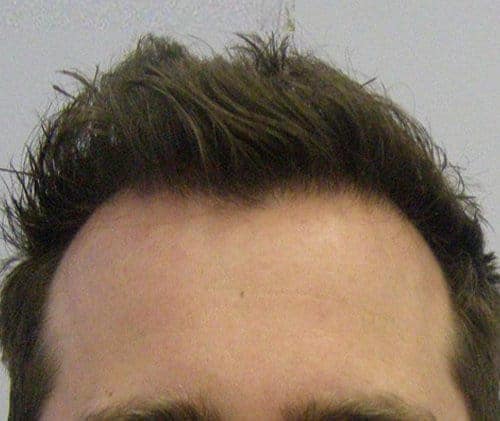 Patient 7 frontal view after hair transplant