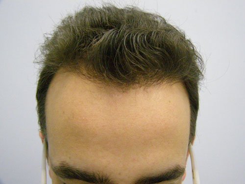 Patient 19 After Hair Transplant top front view