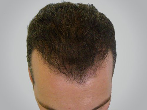 Patient 19 After Hair Transplant top view