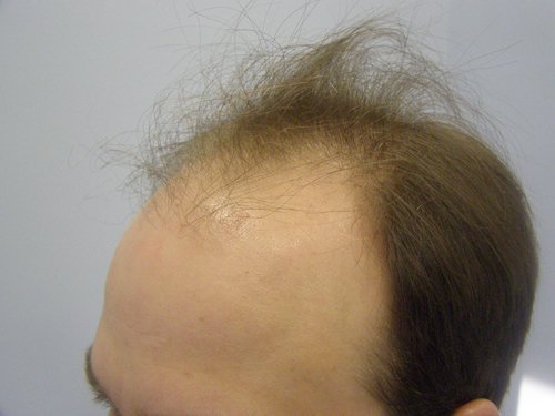 Hair Transplant Patient 17 Before left side