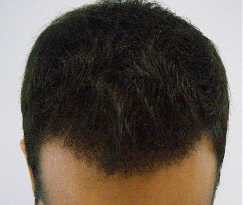 Patient 8 South Asian male top view after hair transplant