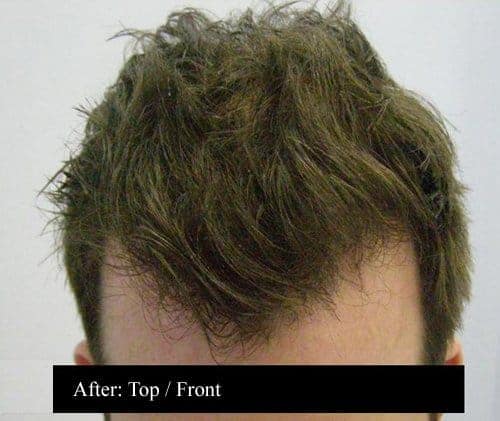 Top After Hair Transplant