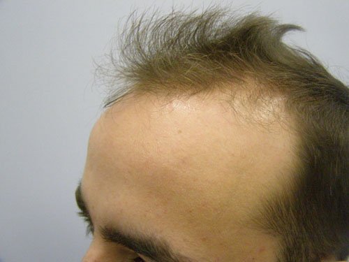 Patient 19 Before Hair Transplant left side view
