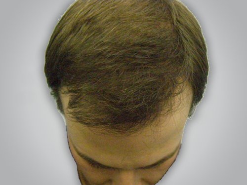 Hair Transplant Patient 17 After top view