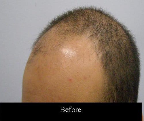 Patient 8 South Asian male left side before hair transplant