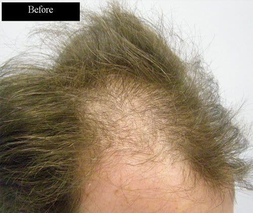 Patient 7 right side before hair transplant