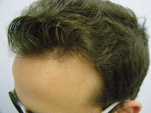Patient 19 After Hair Transplant left side view