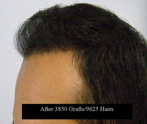 Patient 8 South Asian male left side after hair transplant