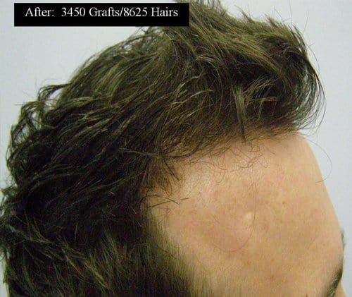 Patient 7 right side after hair transplant