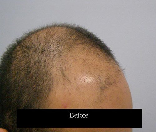Patient 8 South Asian male right side before hair transplant