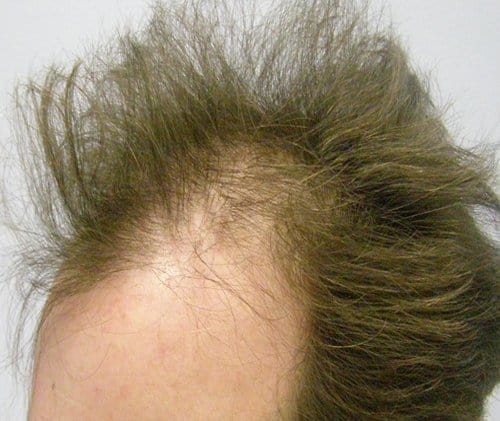 Patient 7 left side before hair transplant
