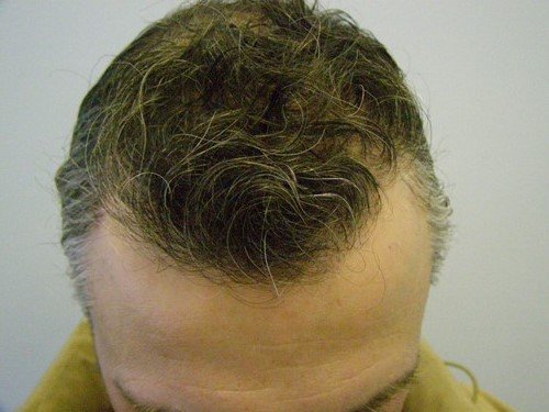 Hair Transplant Patient 16 after top front view