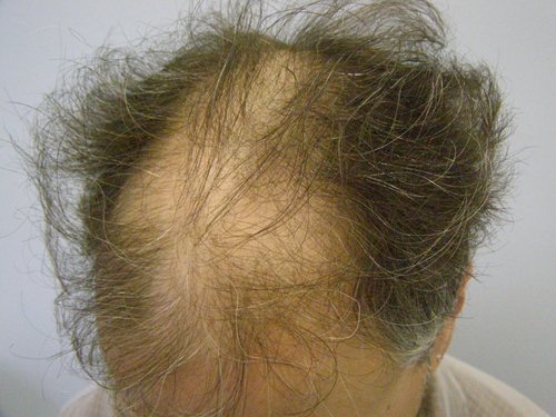 Hair Transplant Patient 16 before top front view