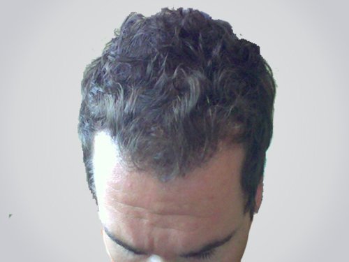 Patient 14 After Hair Transplant top view