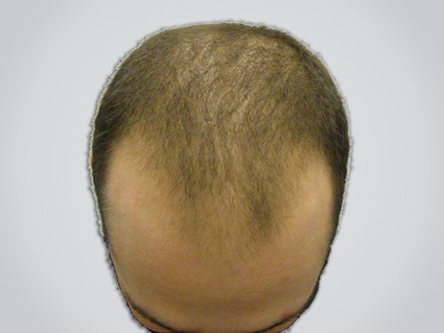 Patient 14 Before Hair Transplant top view