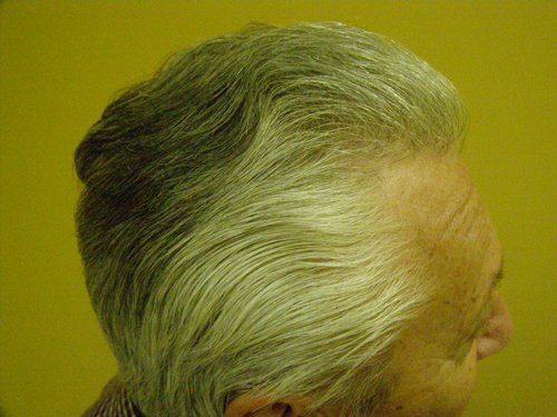 Senior blonde male top right side after hair transplant