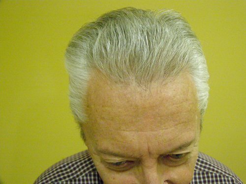Senior blonde male front view after hair transplant