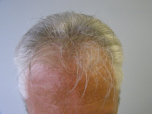 Senior blonde male front view before hair transplant