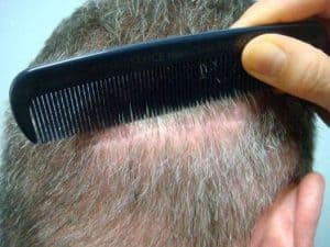 Hair Transplant donor area after
