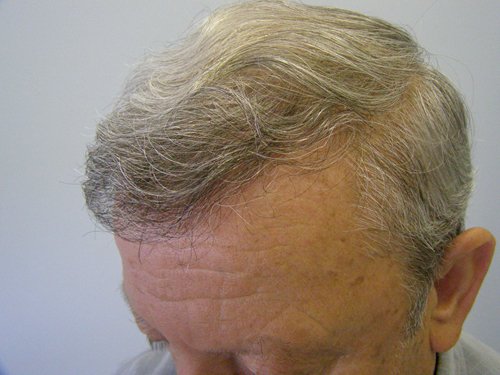 Front Left Senior grey hair male after hair transplant