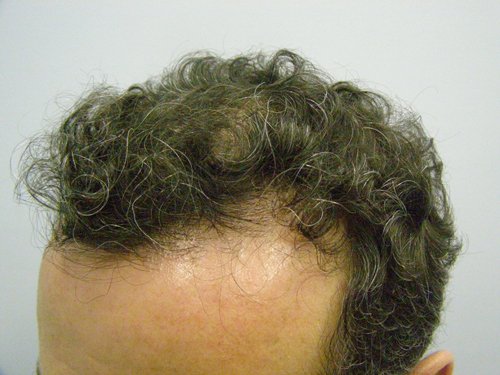 Wavy Hair male left side after hair transplant