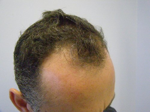 Wavy Hair male right side before hair transplant