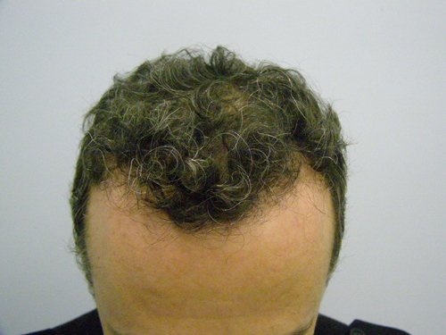 Wavy Hair male top after hair transplant
