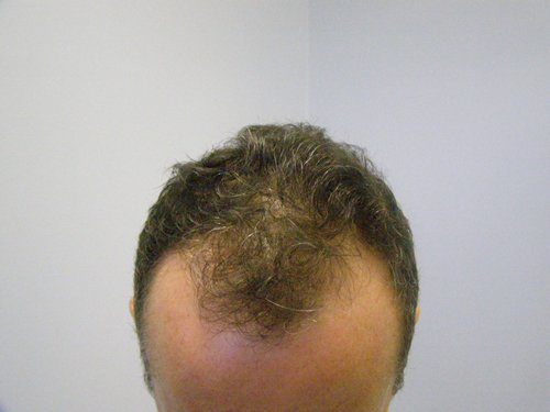 Wavy Hair male top before hair transplant