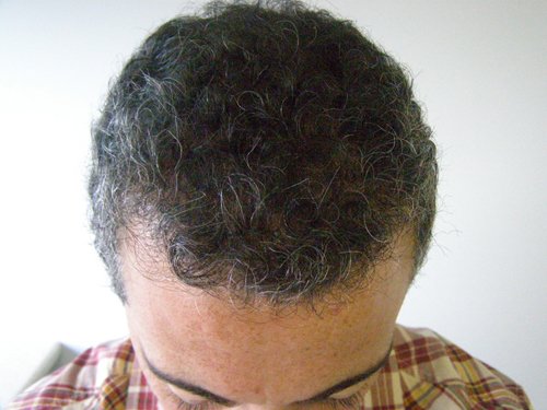 Patient 9 After hair transplant top view