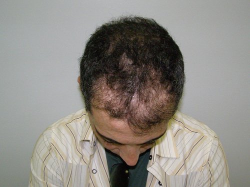 Patient 9 Before hair transplant top view