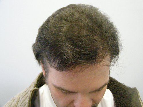 Patient 8 after hair transplant top view