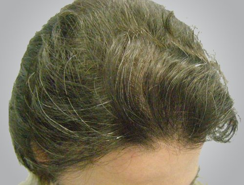 Patient 8 after hair transplant top right side view