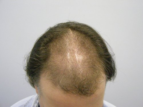 Patient 8 Before hair transplant top view