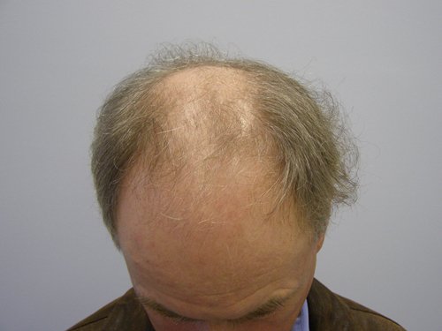 Grey Hair male before hair transplant top view