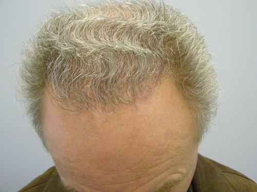 Grey Hair male after hair transplant top view