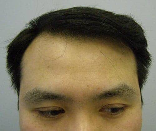 After Hair Transplant Front