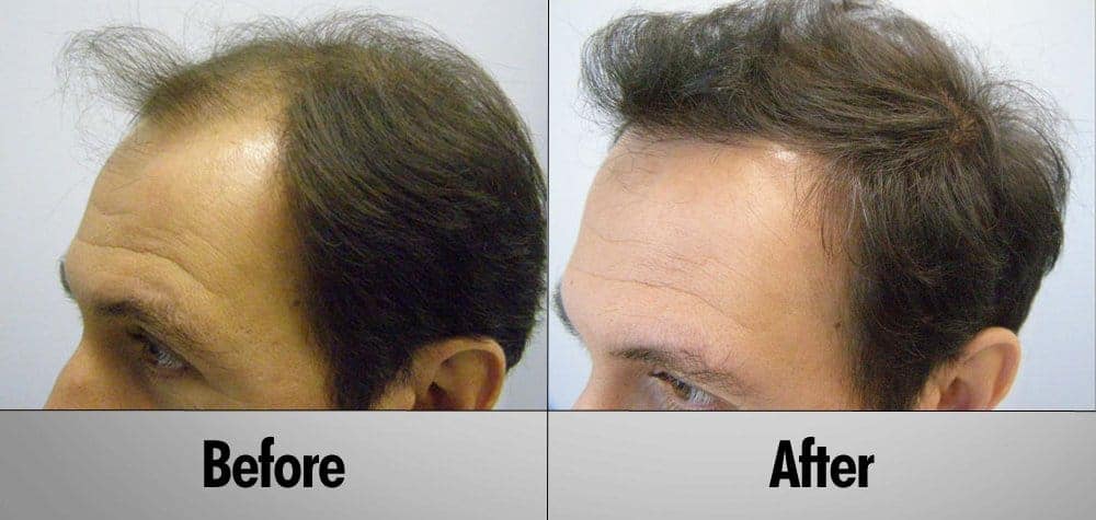 Patient 21 Before and After Hair transplant