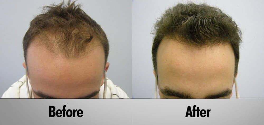 Patient 19 Before and After Hair Transplant