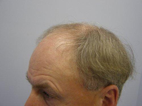 Grey Hair male before hair transplant left side view