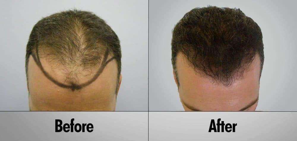 Patient 19 Before and After Hair Transplant top view