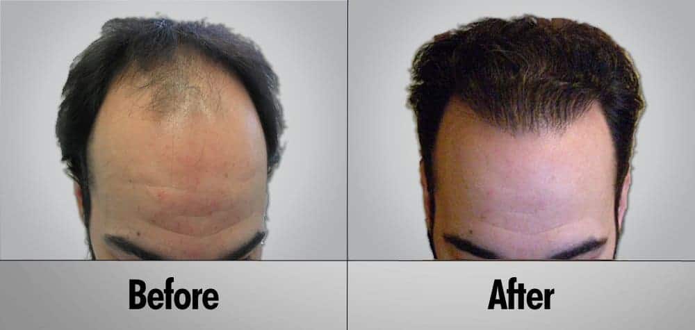 Hair Transplant Patient18 Before and After