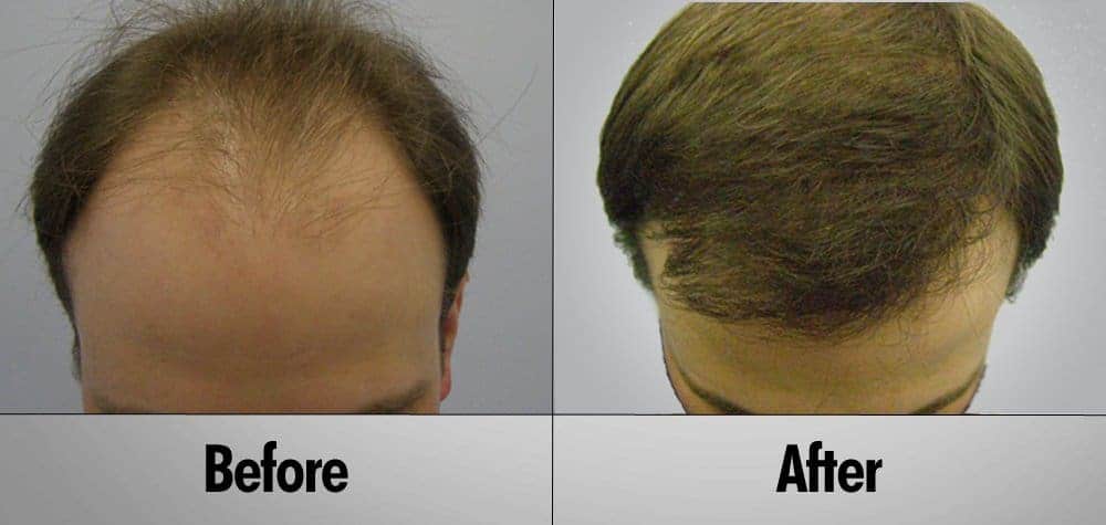 Hair Transplant Patient 17 Before and After top view