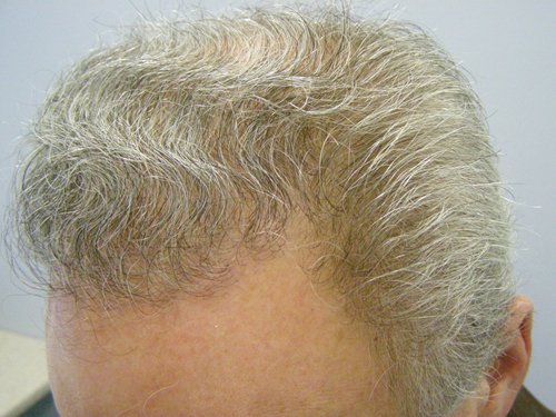 Grey Hair male after hair transplant left side view